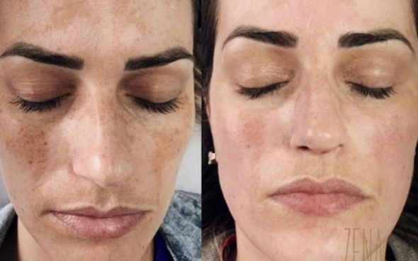 Zena Algae Peel | House of Beauty Laser Studio